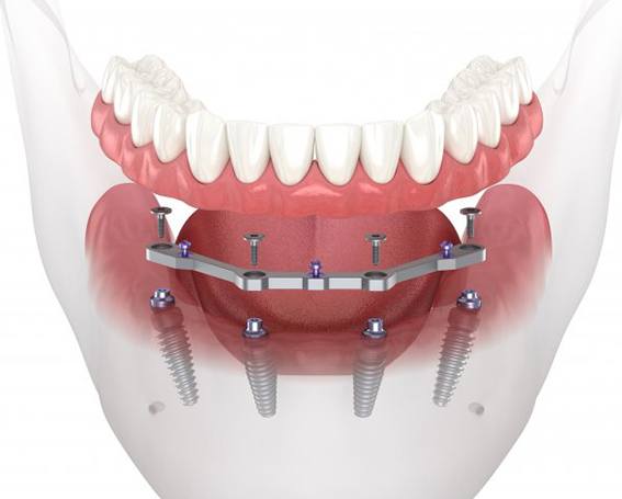 a 3D illustration of All-On-4 dental implants