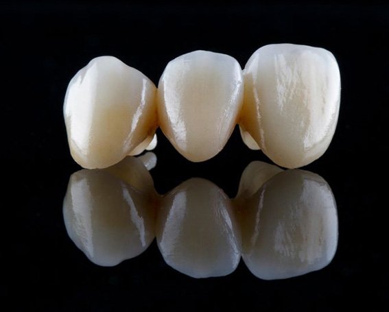 Dental bridge on dark reflective surface