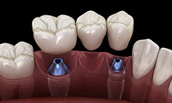 Illustration of three-unit dental implant bridge