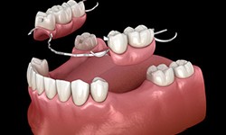 a graphic model of partial dentures