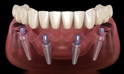 a closeup of implant dentures in Leesburg