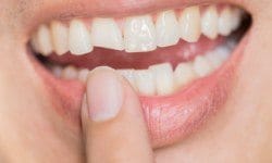 Closeup of smile with chipped front tooth