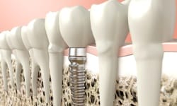 Dental implant in Leesburg