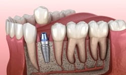 Dental implant in Leesburg
