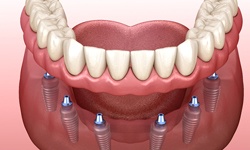 diagram of implants getting the restoration