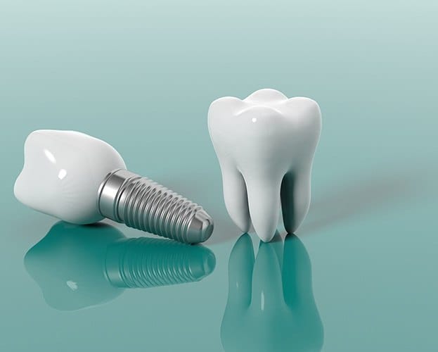 Animated dental implant supported dental crown compared to natural tooth