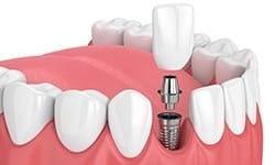 Animated smile during dental implant supported dental crown placement