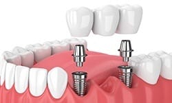 Animated smile during dental implant supported fixed bridge placement