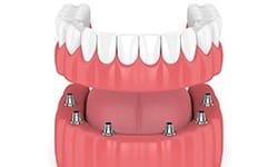 Animated smile during dental implant supported denture placement