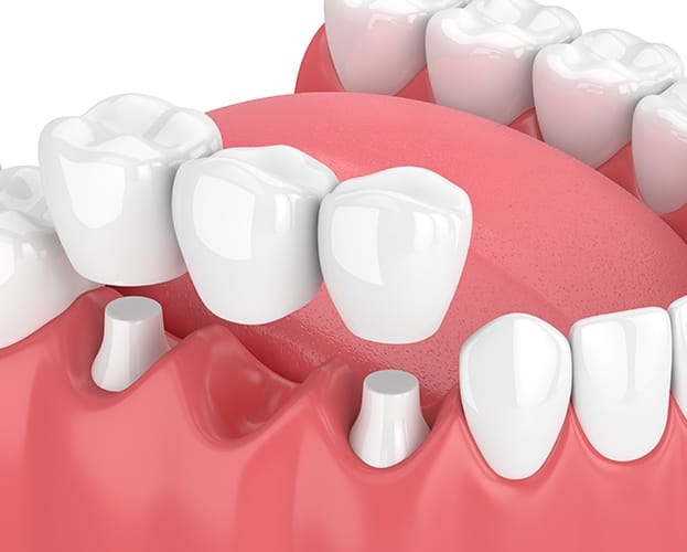 Animated smile during dental bridge placement to replace missing teeth