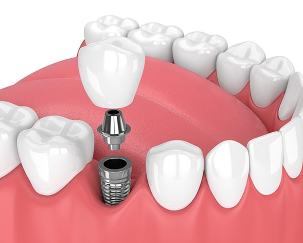 Animated dental implant supported dental crown