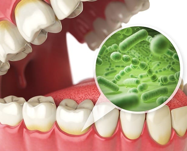 Animated smile with zoomed in bacteria representing gum disease