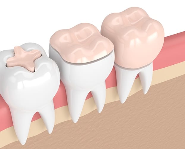 Animated teeth comparing different dental restorations