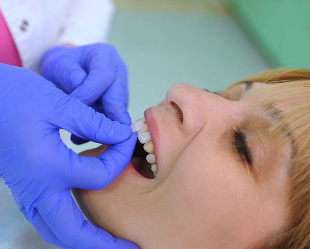 Dentist placing porcelain veneers