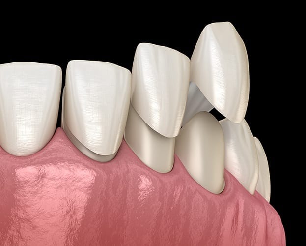 Animated smile during porcelain veneer placement